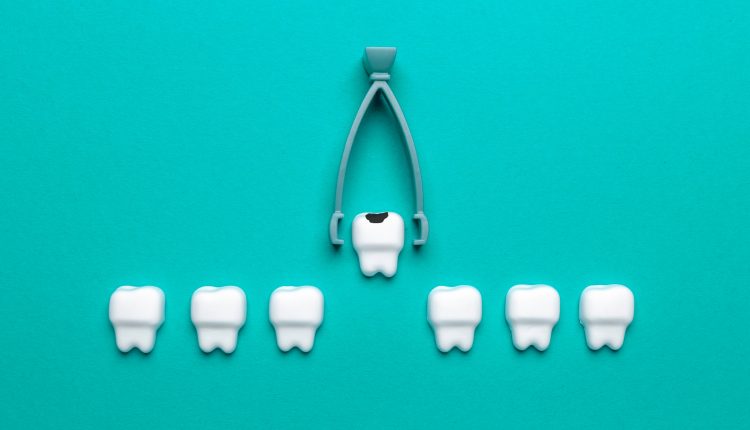 Wisdom Teeth Removal: What to Expect Before, During, and After