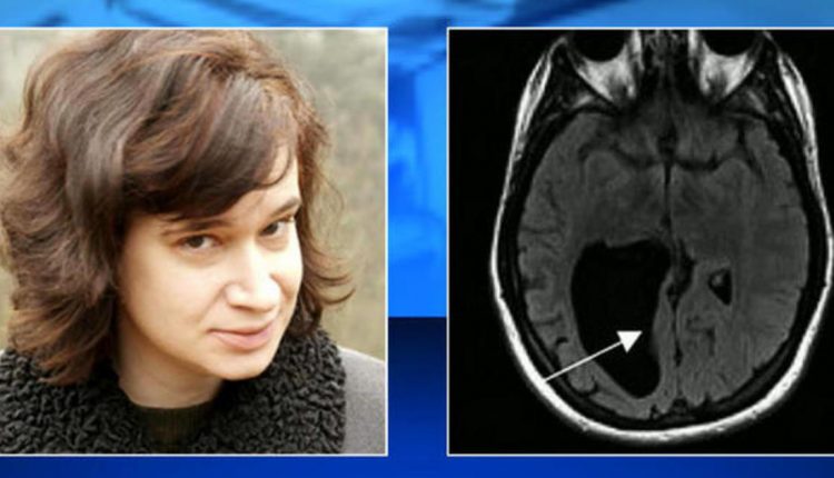 Woman learns of lemon-sized hole in her brain