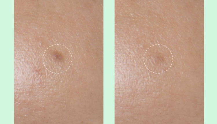 Want to Get Rid of Dark Spots? These $28 Patches May ‘Dissolve’ Them